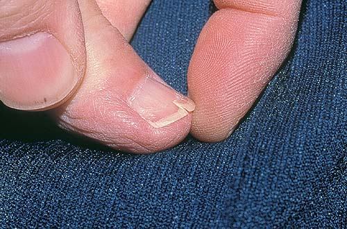 Заболевания ногтей
